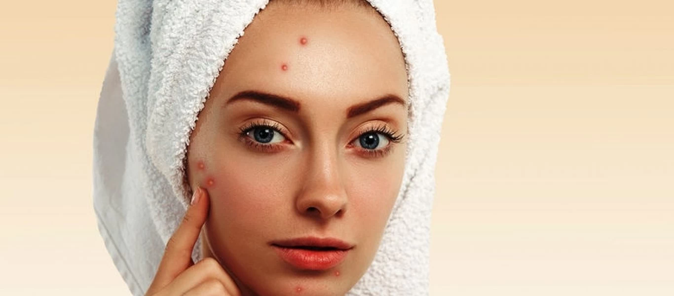 Είναι φυσιολογική η εφηβική ακμή; - Τι δείχνουν οι έρευνες